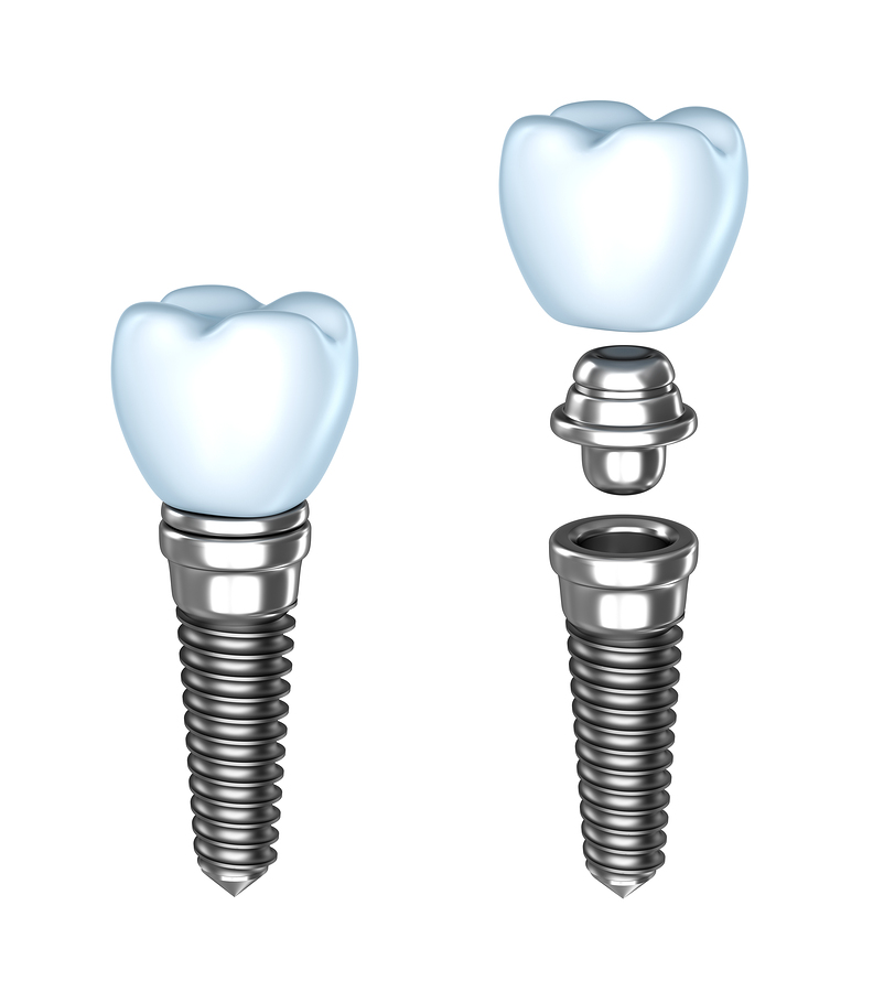 Implant Restoration | Dentist In Los Altos, CA | Main Dental LLC